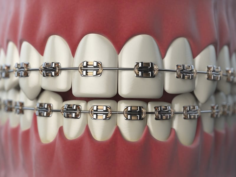 Dental Veneers